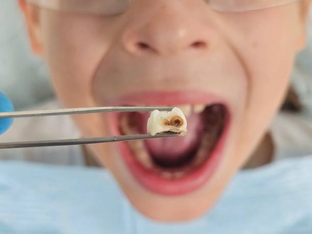 Best Emergency Tooth Extraction in Cade, LA