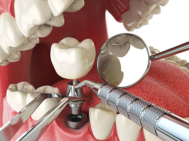 Best Emergency Broken Tooth Repair in Cade, LA